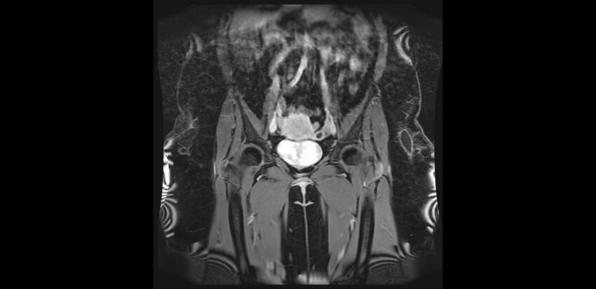 Buttock filler complications (Radiopaedia 63497-72115 Coronal T1 C+ 10).jpg