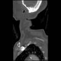 C1 anterior arch (plough) fracture - type 1 (Radiopaedia 76181-87720 Sagittal bone window 10).jpg