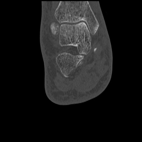 File:Calcaneal tuberosity avulsion fracture (Radiopaedia 22649-22668 Coronal bone window 48).jpg