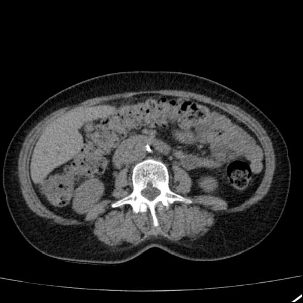 File:Calcified hepatic hydatid cyst (Radiopaedia 26872-27046 Axial non-contrast 44).jpg