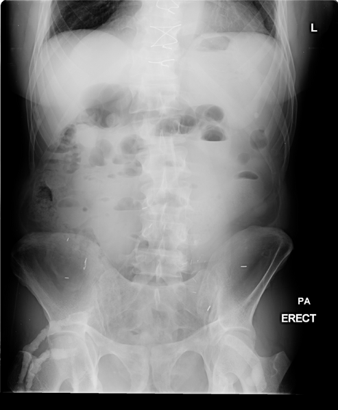 File:Calcified occluded femoral grafts in a renal transplant patient (Radiopaedia 36546-38110 B 1).png