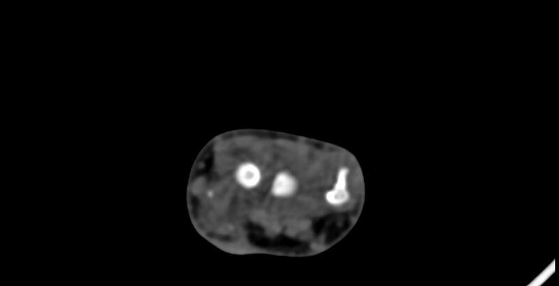 File:Calcifying aponeurotic fibroma (Radiopaedia 88423-105064 B 44).jpg