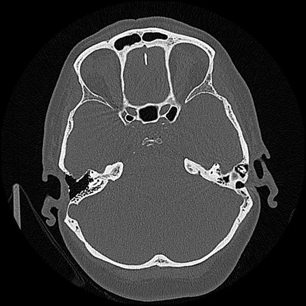 File:Canal up mastoidectomy (Radiopaedia 78108-90638 Axial bone window 99).jpg
