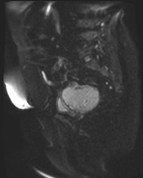 File:Cancer cervix - stage IIb (Radiopaedia 75411-86615 Sagittal DWI 39).jpg