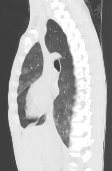 File:Cannabis-induced diffuse alveolar hemorrhage (Radiopaedia 89834-106946 Sagittal lung window 60).jpg