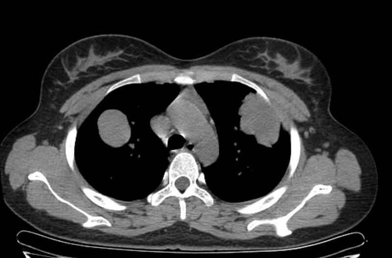 File:Cannonball metastases - uterine choriocarcinoma (Radiopaedia 70137-80173 Axial non-contrast 27).jpg