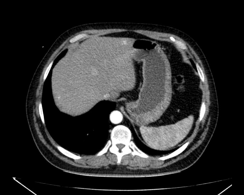 Carcinoid tumor with hepatic metastases (Radiopaedia 22651-22670 B 14).jpg