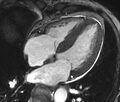 Cardiac amyloidosis (Radiopaedia 39736-42124 D 22).jpg