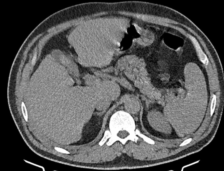 File:Cardiogenic pulmonary edema (Radiopaedia 68180-77678 Axial non-contrast 63).jpg
