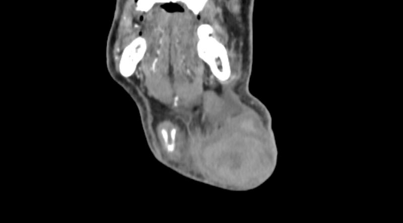 File:Carotid artery pseudoaneurysm (Radiopaedia 84030-99259 D 8).jpg
