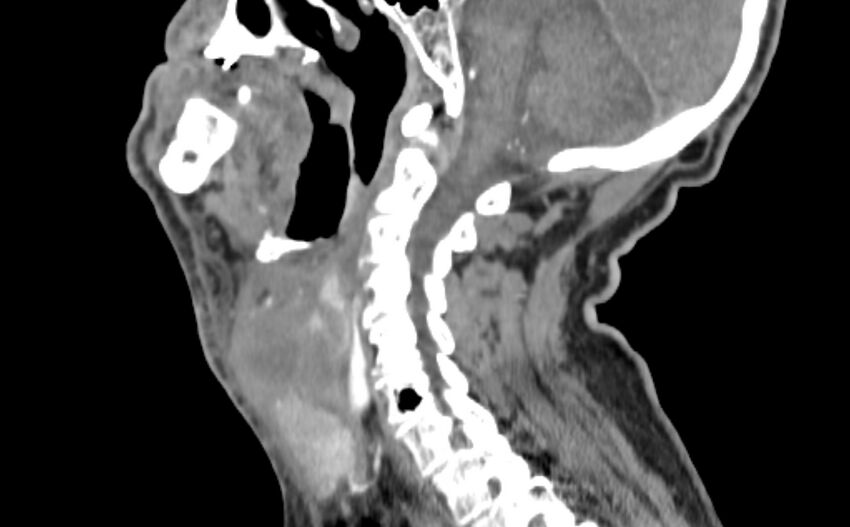 Carotid artery pseudoaneurysm (Radiopaedia 84030-99259 E 14).jpg