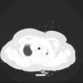 Carotid body tumor (Radiopaedia 21021-20948 Axial lung window 2).jpg