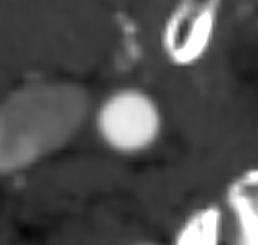 Carotid near-occlusion (Radiopaedia 85304-100887 M 20).jpg