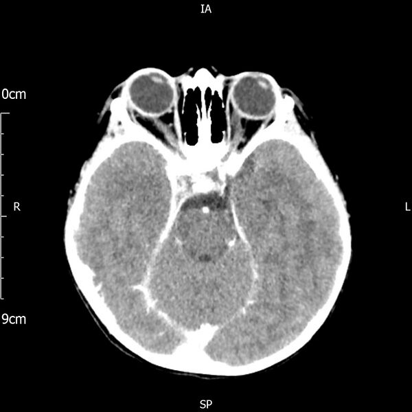 File:Cavernous sinus thrombosis (Radiopaedia 79414-92510 Axial Brain 82).jpg