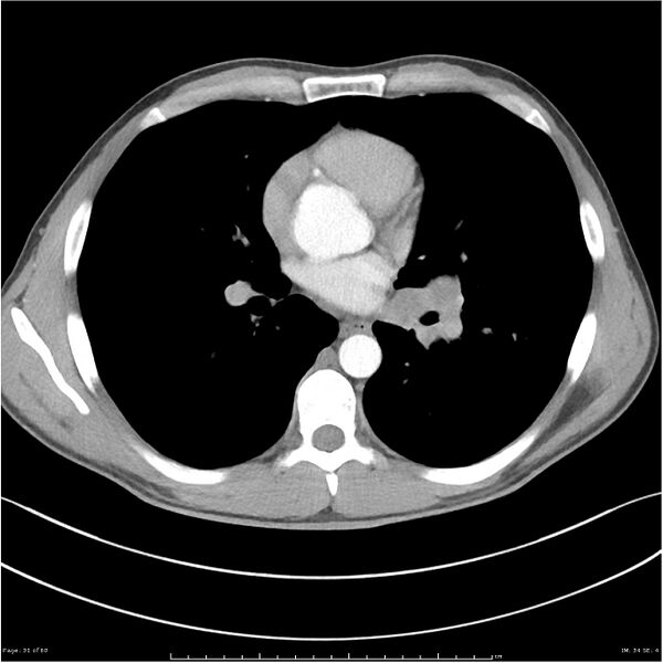 File:Cavitating lung cancer (Radiopaedia 25796-25945 C+ arterial phase 31).jpg