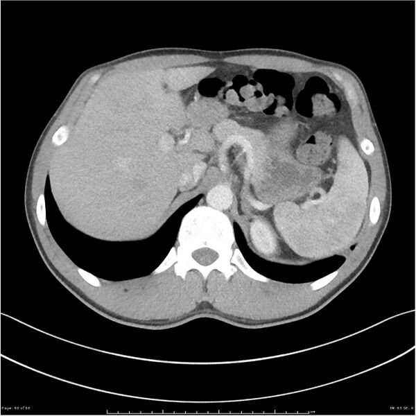 File:Cavitating lung cancer (Radiopaedia 25796-25945 C+ arterial phase 60).jpg