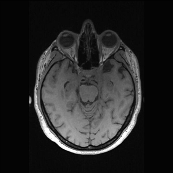 File:Central base of skull meningioma (Radiopaedia 53531-59549 Axial T1 19).jpg