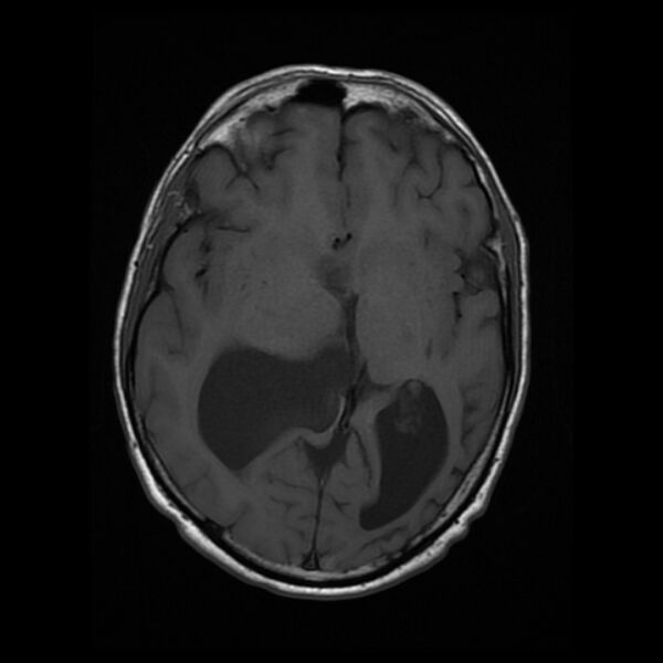 File:Central neurocytoma (Radiopaedia 67618-77021 Axial T1 12).jpg