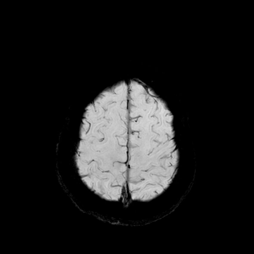 Central neurocytoma (Radiopaedia 79320-92380 Axial SWI 120).jpg