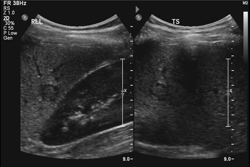 File:Centrifugal enhancement in a liver lesion (CEUS) (Radiopaedia 21641-21593 C 1).jpg