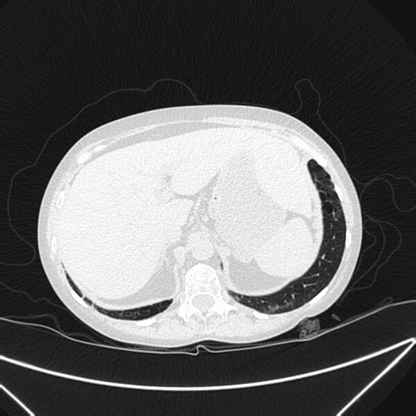 File:Centrilobular pulmonary emphysema (Radiopaedia 24495-24789 Axial lung window 87).jpg
