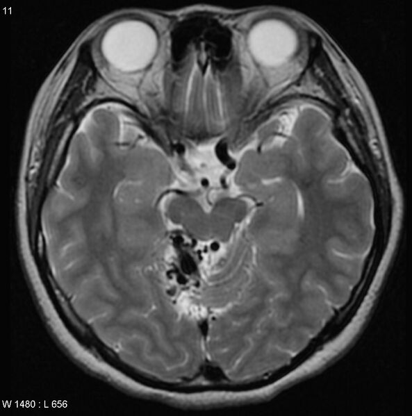 File:Cerebellar arteriovenous malformation (Radiopaedia 5220-6988 Axial T2 7).jpg