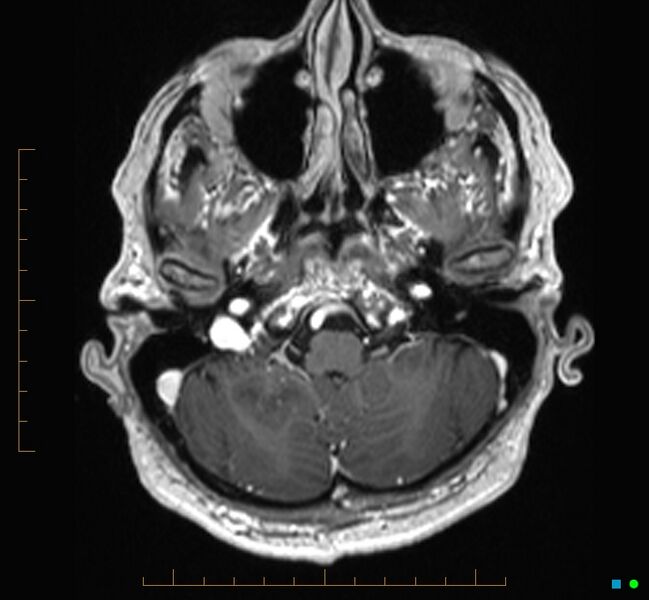 File:Cerebellar gangliocytoma (Radiopaedia 65377-74422 Axial T1 C+ 15).jpg