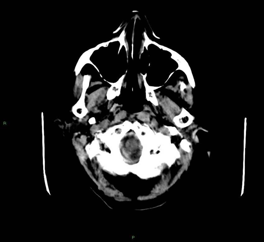 Cerebellar hemorrhage (Radiopaedia 58792-66026 Axial non-contrast 47).jpg