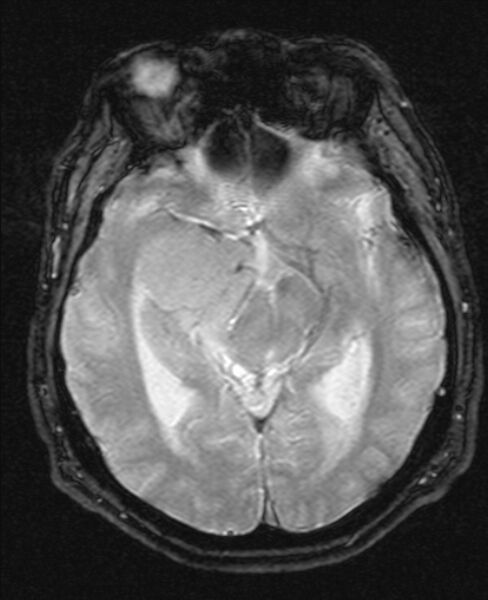 File:Cerebellopontine angle meningioma (Radiopaedia 24459-24764 Axial Gradient Echo 10).jpg