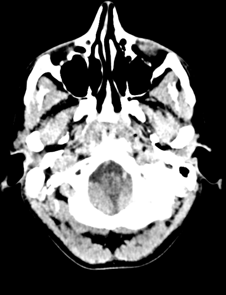 File:Cerebral abscess (Radiopaedia 60342-68008 Axial non-contrast 7).png