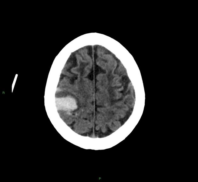 File:Cerebral amyloid angiopathy-associated lobar intracerebral hemorrhage (Radiopaedia 58376-65513 Axial non-contrast 12).jpg