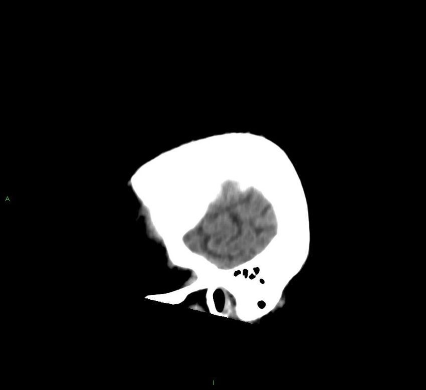 Cerebral amyloid angiopathy-associated lobar intracerebral hemorrhage (Radiopaedia 58376-65513 C 59).jpg