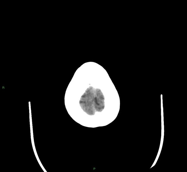 File:Cerebral amyloid angiopathy-associated lobar intracerebral hemorrhage (Radiopaedia 58377-65514 Axial non-contrast 4).jpg
