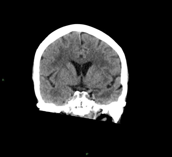 File:Cerebral amyloid angiopathy-associated lobar intracerebral hemorrhage (Radiopaedia 58378-65516 Coronal non-contrast 38).jpg