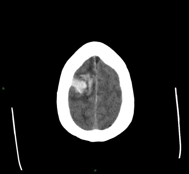 File:Cerebral amyloid angiopathy-associated lobar intracerebral hemorrhage (Radiopaedia 58560-65723 Axial non-contrast 10).jpg