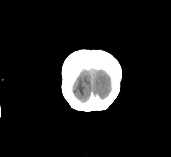 File:Cerebral amyloid angiopathy-associated lobar intracerebral hemorrhage (Radiopaedia 58561-65724 Coronal non-contrast 7).jpg