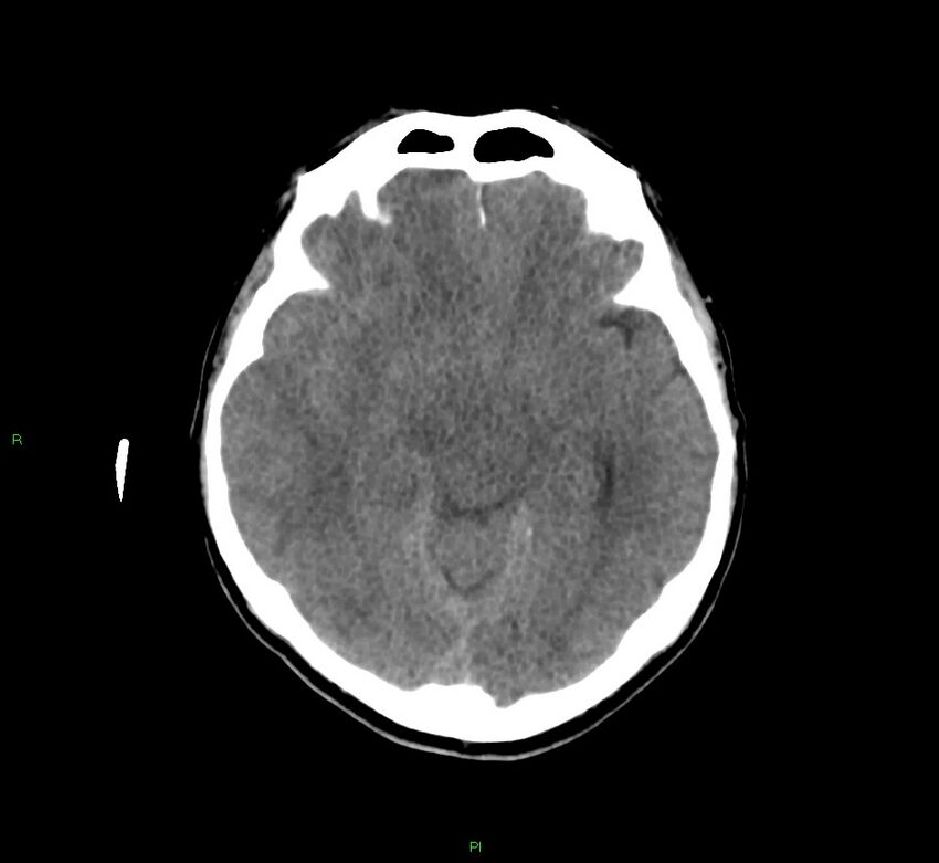 Cerebral amyloid angiopathy-associated lobar intracerebral hemorrhage (Radiopaedia 58756-65977 Axial non-contrast 32).jpg