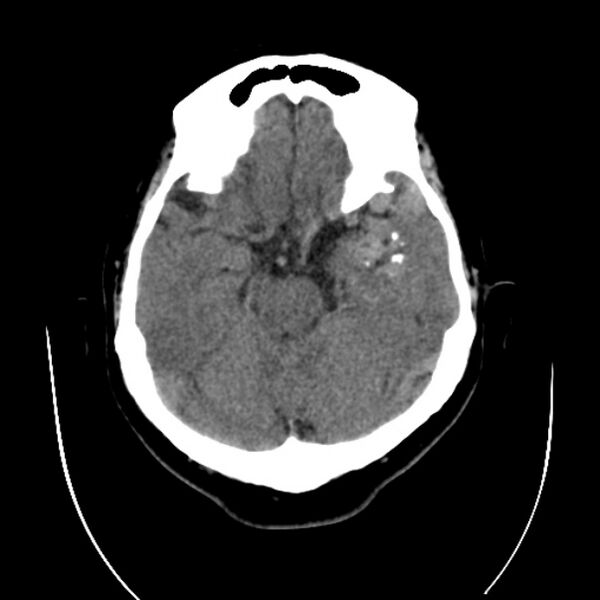 File:Cerebral arteriovenous malformation (Radiopaedia 43729-47189 Axial non-contrast 13).jpg