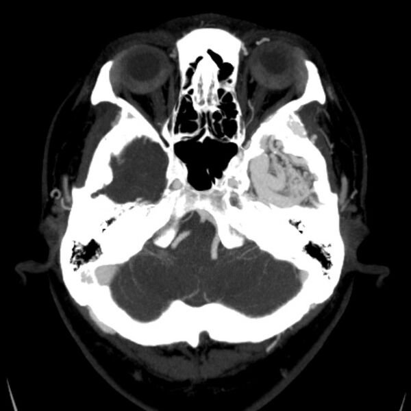 File:Cerebral arteriovenous malformation (Radiopaedia 43729-47189 B 10).jpg