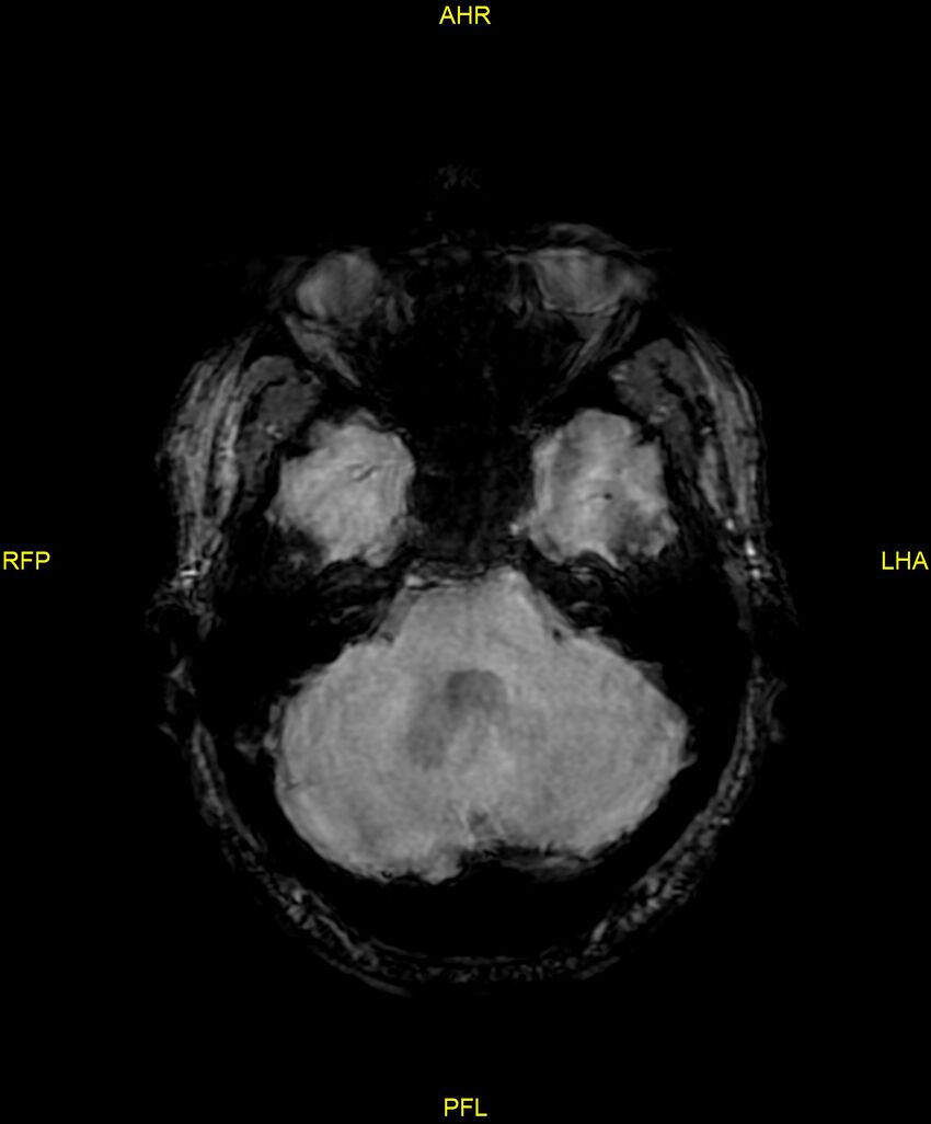 Cerebral autosomal dominant arteriopathy with subcortical infarcts and leukoencephalopathy (CADASIL) (Radiopaedia 86108-102054 Axial SWI 31).jpg