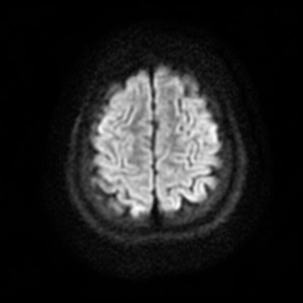 File:Cerebral cavernous malformation (Radiopaedia 44301-47942 Axial DWI 18).jpg