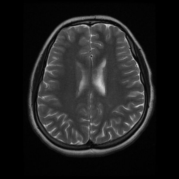 File:Cerebral cavernous malformation (Radiopaedia 44301-47942 Axial T2 14).jpg