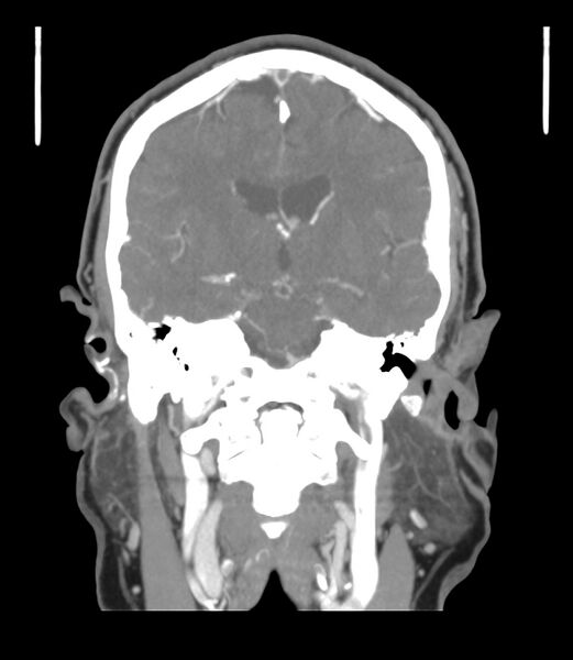 File:Cerebral dural venous sinus thrombosis (Radiopaedia 86514-102576 B 36).jpg