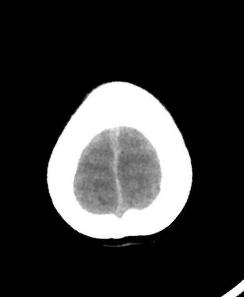 File:Cerebral edema due to severe hyponatremia (Radiopaedia 89826-106937 Axial non-contrast 86).jpg
