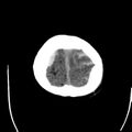 Cerebral hemorrhagic contusions (Radiopaedia 23145-23188 Axial non-contrast 38).jpg