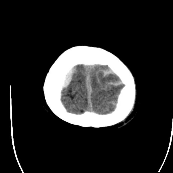 File:Cerebral hemorrhagic contusions (Radiopaedia 23145-23188 Axial non-contrast 38).jpg