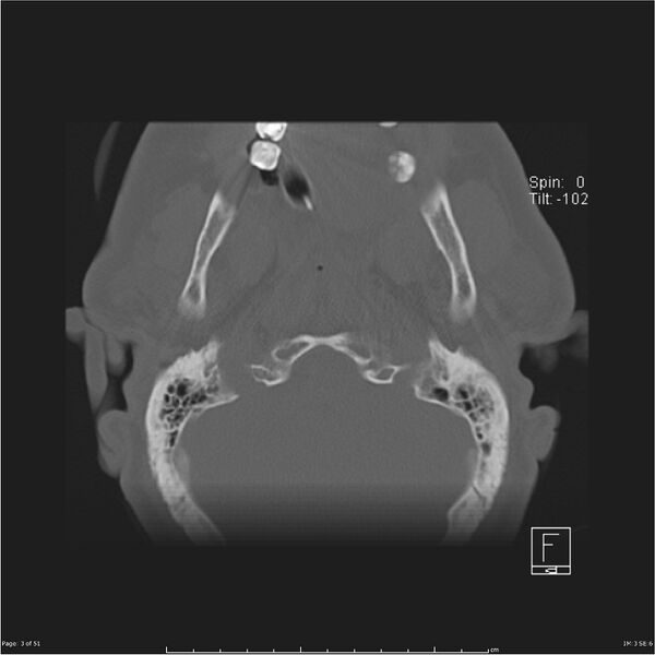 File:Cerebral hemorrhagic contusions and cervical spine fractures (Radiopaedia 32865-33841 C 3).jpg