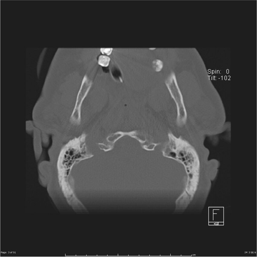 Cerebral hemorrhagic contusions and cervical spine fractures (Radiopaedia 32865-33841 C 3).jpg