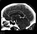 Cerebral vein thrombosis (Radiopaedia 4408-6629 C 1).jpg