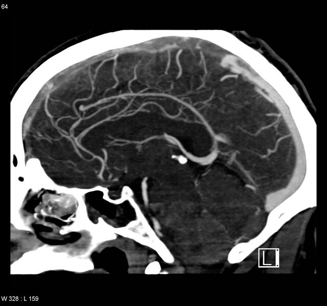 File:Cerebral vein thrombosis (Radiopaedia 4408-6629 C 1).jpg